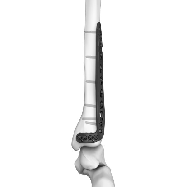 Distal Lateral Tibial Locking Plate