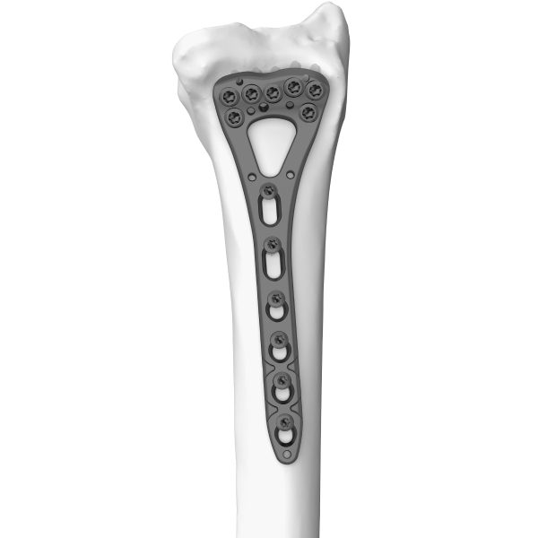 Distal Radius Locking Plate Variable Angle Small