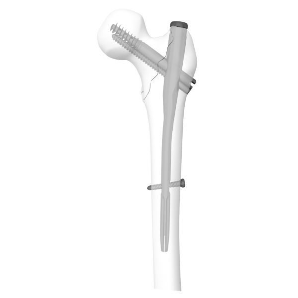 Proximal Femoral Compression Nail